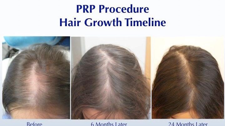 Prp Hair Treatment For Women